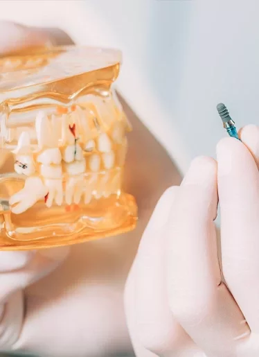 implant dentaire Tunisie tarif