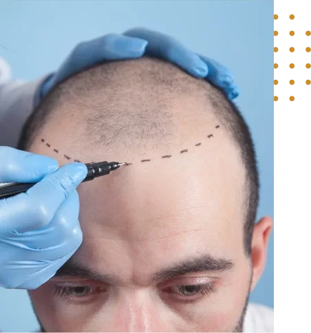 Prix implant capillaire Tunisie