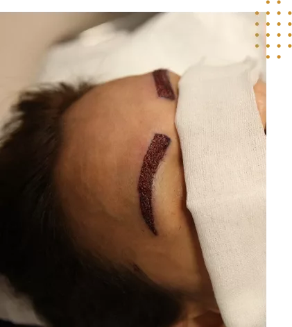 Implant de sourcils en Tunisie